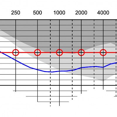Audiometry: Sources of error and pitfalls in interpretation