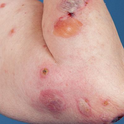 Pemphigoid diseases